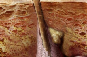 Curso Experto en Fisiología Cutánea y Bases de la Fisiopatología