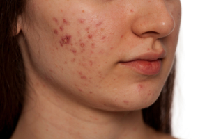 MasterClass Especializado en Fisiopatología Estética del Acné